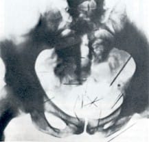 albert fish